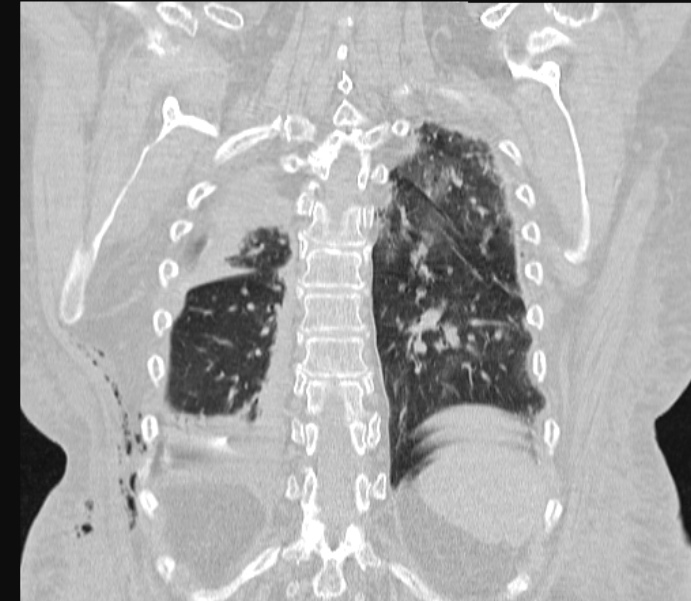 Barotrauma due to mechanical ventilation (Radiopaedia 28079-28336 Coronal lung window 73).jpg