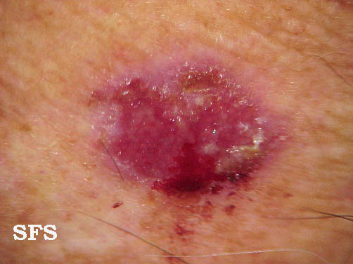 Basal Cell Carcinoma (Dermatology Atlas 7).jpg