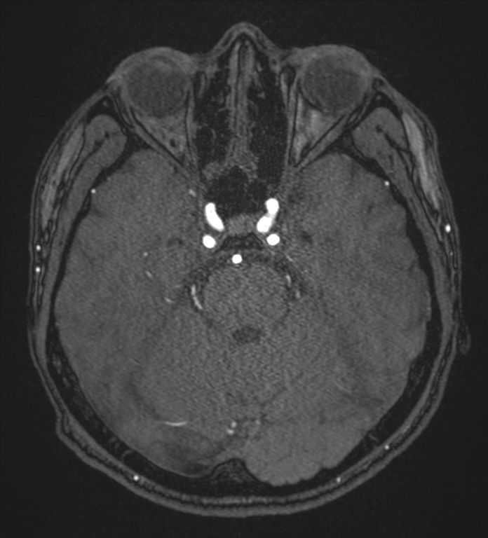 Basal ganglia subacute infarct (Radiopaedia 80201-93521 Axial MRA 35).png