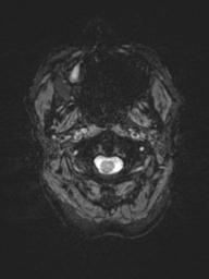 Base of skull chondrosarcoma (Radiopaedia 30410-31070 Axial SWI 1).jpg