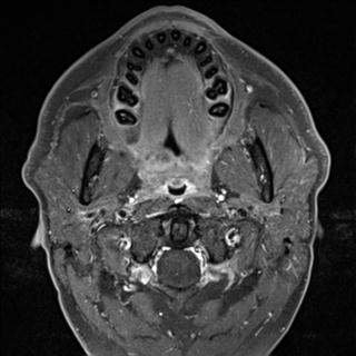 File:Base of tongue squamous cell carcinoma (Radiopaedia 31174-31884 Axial T1 C+ fat sat 27).jpg