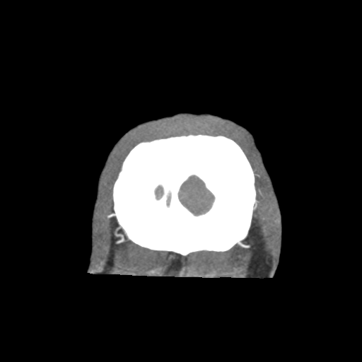 Basilar and bilateral vertebral artery occlusion (Radiopaedia 45592-49723 B 96).png