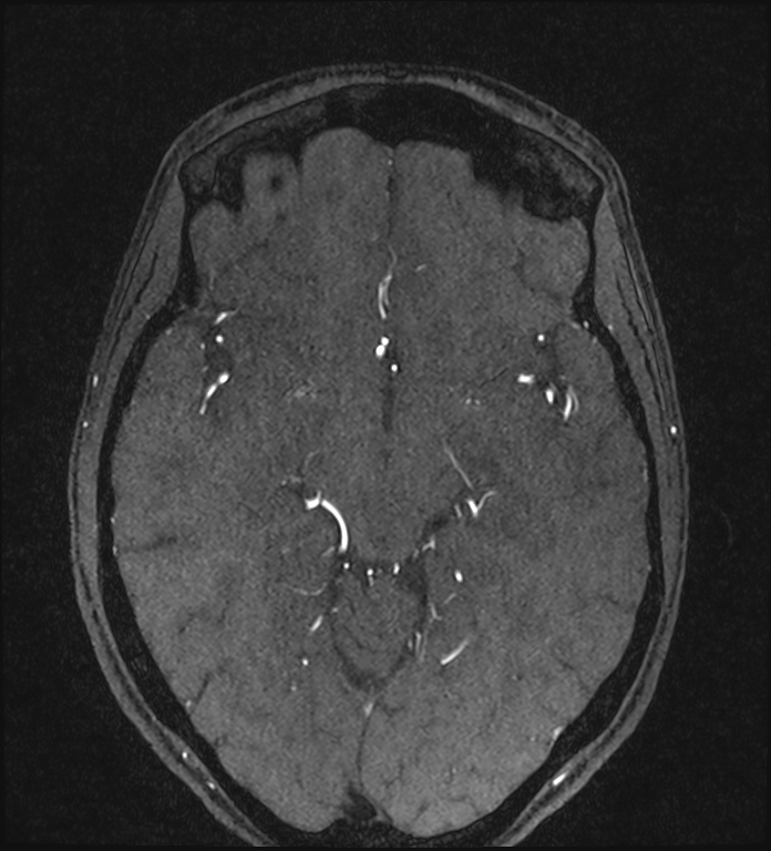 Basilar artery perforator aneurysm (Radiopaedia 82455-97733 Axial MRA 115).jpg