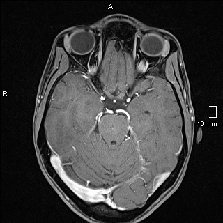 Basilar artery perforator aneurysm (Radiopaedia 82455-99523 G 50).jpg