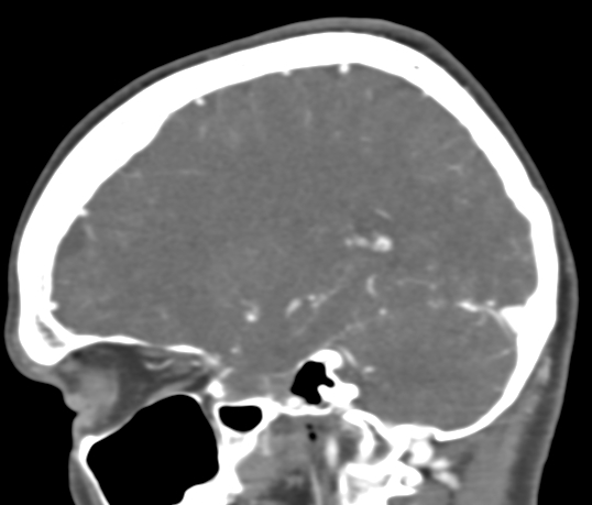 Basilar tip aneurysm with coiling (Radiopaedia 53912-60086 C 42).jpg