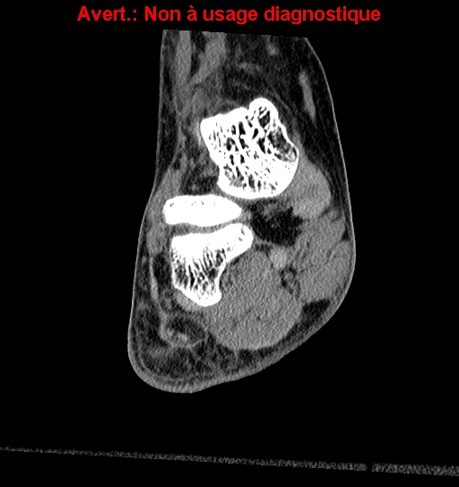 Baxter neuropathy (Radiopaedia 25988-26125 Coronal non-contrast 8).jpg