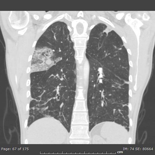 File:Behçet disease (Radiopaedia 44247-47889 Coronal lung window 18).jpg