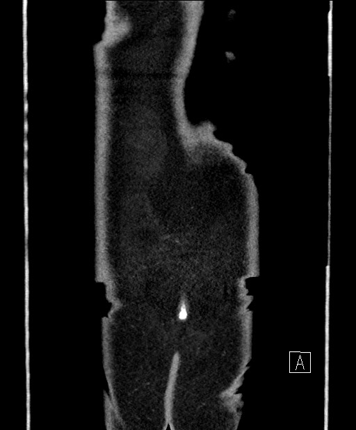 Benign colonic stricture with colo-colonic fistula (Radiopaedia 59439-66800 A 80).jpg