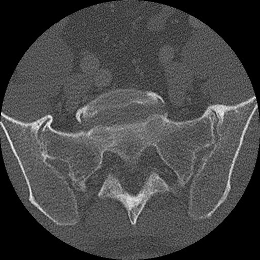 Benign post-traumatic pseudopneumoperitoneum (Radiopaedia 71199-81495 Axial bone window 288).jpg