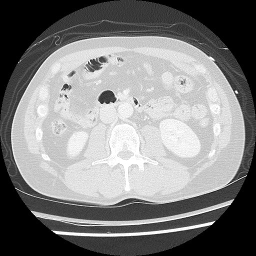 Benign post-traumatic pseudopneumoperitoneum (Radiopaedia 71199-81495 Axial lung window 88).jpg