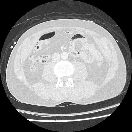 Benign post-traumatic pseudopneumoperitoneum (Radiopaedia 71199-81495 Axial lung window 93).jpg