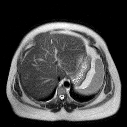 File:Benign seromucinous cystadenoma of the ovary (Radiopaedia 71065-81300 Axial T2 18).jpg