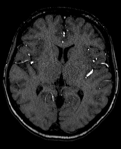 Berry aneurysm of the terminal internal carotid artery (Radiopaedia 88286-104918 Axial TOF 130).jpg