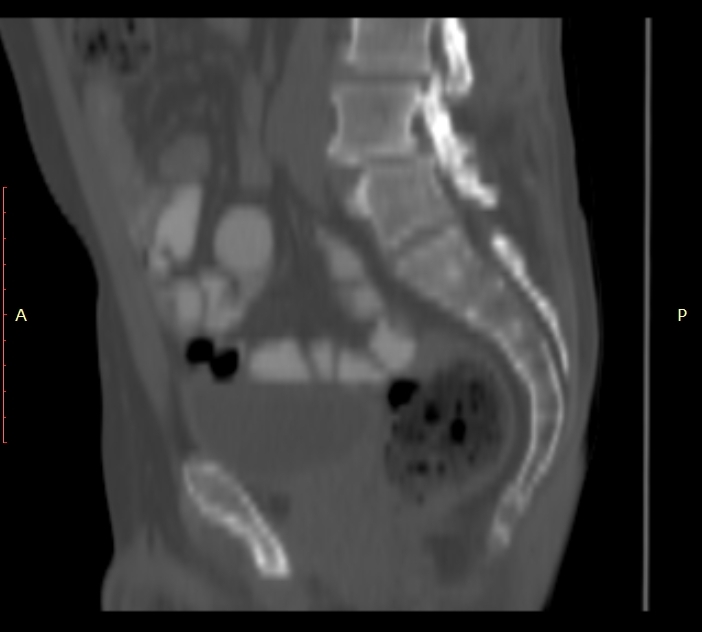 Bertolotti syndrome (Radiopaedia 58974-66235 Sagittal bone window 21).jpg