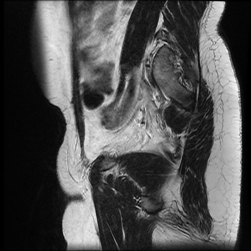File:Bicornuate uterus (Radiopaedia 51676-57472 Sagittal T2 7).jpg