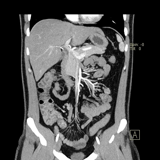 File:Bilateral accessory renal arteries with mild pelvi-ureteric junction (PUJ) obstruction (Radiopaedia 66357-75596 B 6).jpg