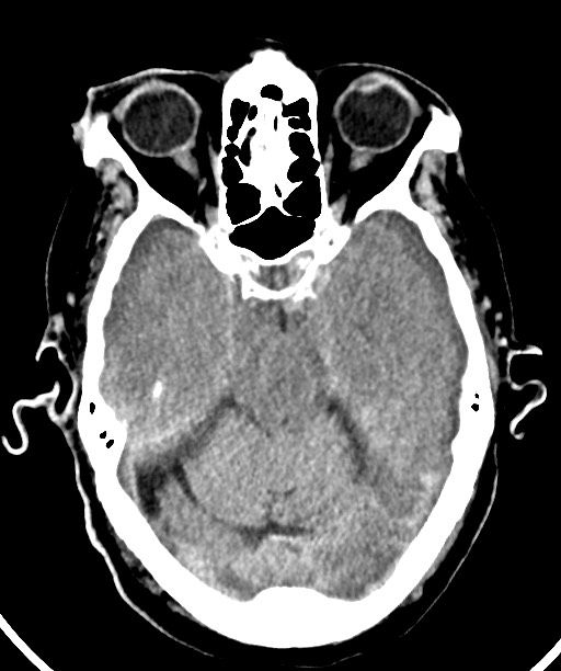 Bilateral acute on chronic subdural hematomas (Radiopaedia 78466-91146 Axial non-contrast 22).jpg