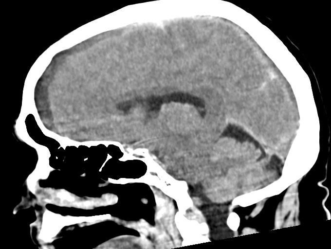 Bilateral acute on chronic subdural hematomas (Radiopaedia 78466-91146 C 28).jpg