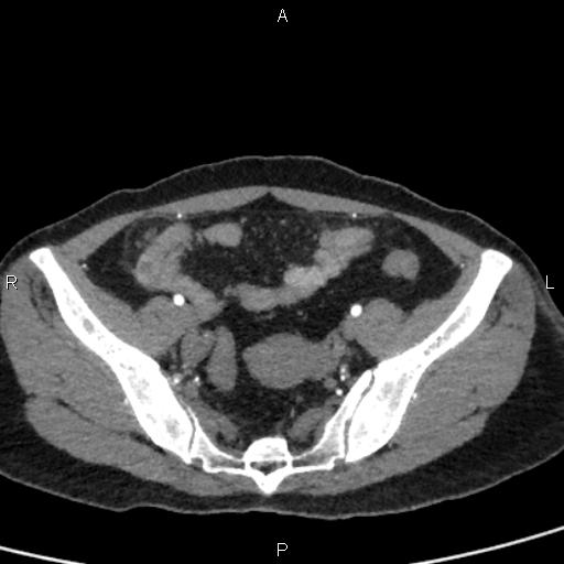 Bilateral adrenal gland hyperenhancement in pancreatitis (Radiopaedia 86642-102753 B 105).jpg