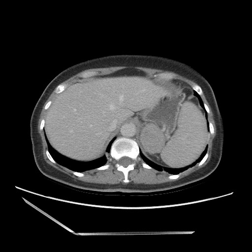Bilateral adrenal granulocytic sarcomas (chloromas) (Radiopaedia 78375-91007 A 25).jpg