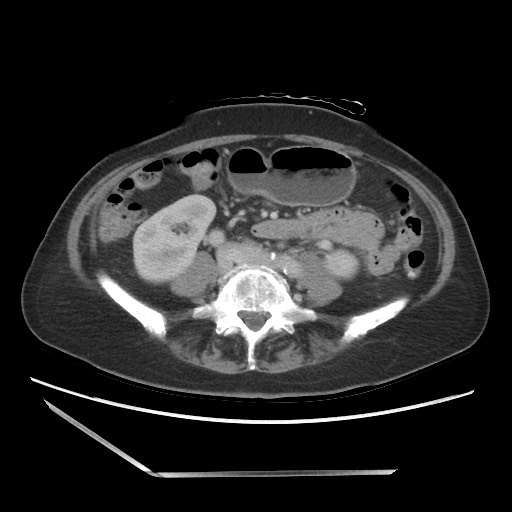 File:Bilateral adrenal granulocytic sarcomas (chloromas) (Radiopaedia 78375-91007 A 71).jpg