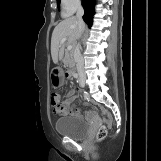 Bilateral adrenal granulocytic sarcomas (chloromas) (Radiopaedia 78375-91007 C 67).jpg