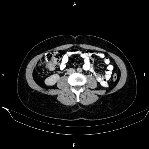 Bilateral adrenal myelolipoma (Radiopaedia 63058-71535 Axial C+ delayed 82).jpg
