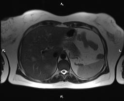 File:Bilateral adrenal myelolipoma (Radiopaedia 63058-71537 Axial T2 10).jpg