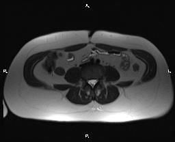 File:Bilateral adrenal myelolipoma (Radiopaedia 63058-71537 Axial T2 28).jpg