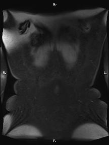 Bilateral adrenal myelolipoma (Radiopaedia 63058-71537 Coronal T1 fat sat 3).jpg