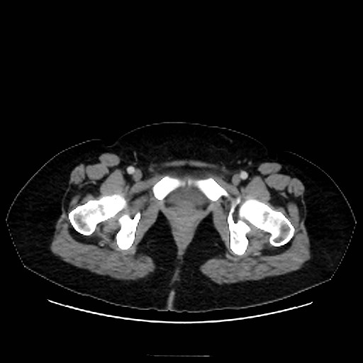 Bilateral adrenal thrombosis (Radiopaedia 58182-65256 A 79).jpg