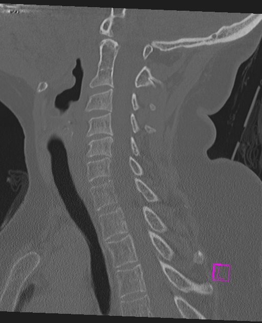 Bilateral atlanto-occipital assimilation (Radiopaedia 28350-28603 Sagittal bone window 44).jpg