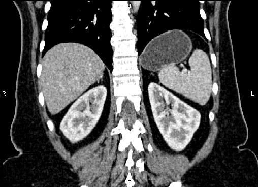 Bilateral benign adrenal adenomas (Radiopaedia 86912-103124 D 47).jpg