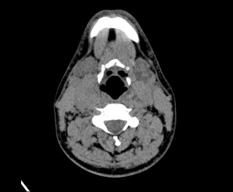 Bilateral carotid body tumors (Radiopaedia 61841-69870 Axial non-contrast 54).jpg