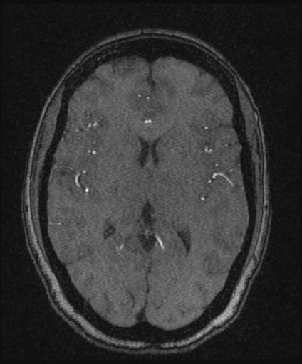 Bilateral carotid body tumors and right glomus jugulare tumor (Radiopaedia 20024-20060 Axial MRA 100).jpg
