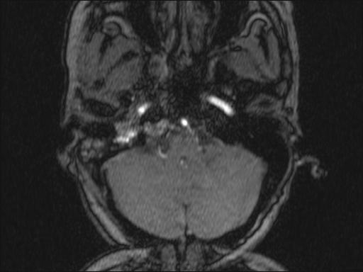 Bilateral carotid body tumors and right glomus jugulare tumor (Radiopaedia 20024-20060 Axial MRA 312).jpg