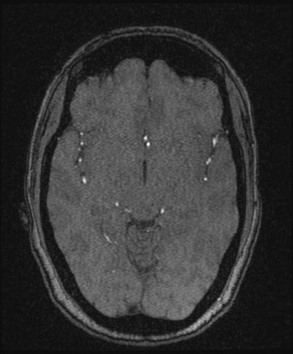 Bilateral carotid body tumors and right glomus jugulare tumor (Radiopaedia 20024-20060 Axial MRA 84).jpg