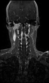 File:Bilateral carotid body tumors and right glomus jugulare tumor (Radiopaedia 20024-20060 MRA 44).jpg