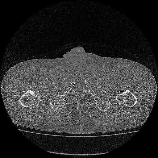 Bilateral femoral neck stress fractures (Radiopaedia 28666-28954 Axial bone window 85).png