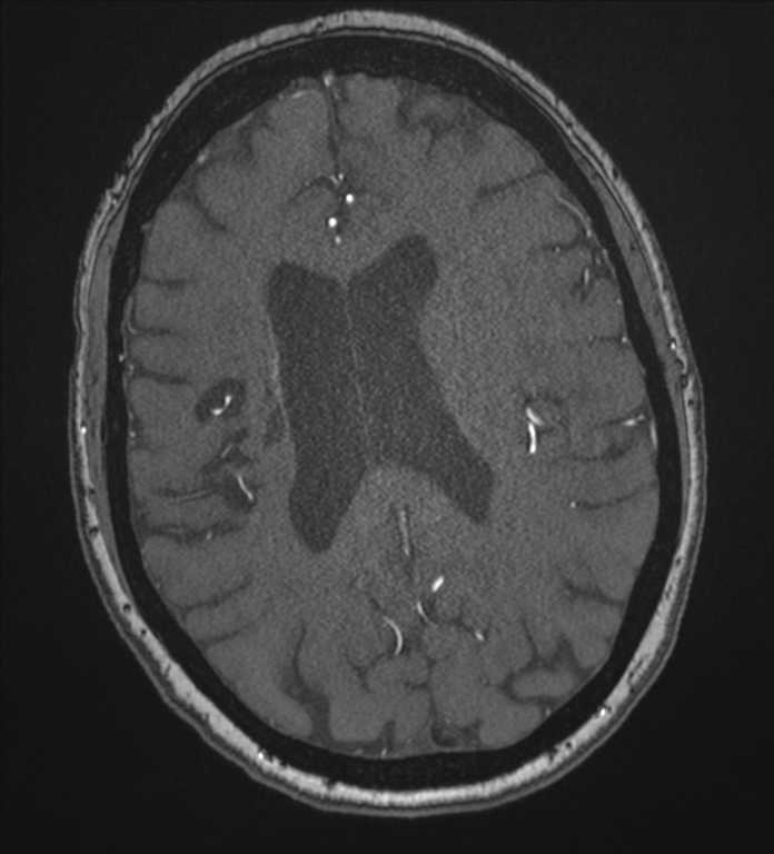 Bilateral fetal posterior communicating arteries (Radiopaedia 41286-44102 Axial MRA 140).png