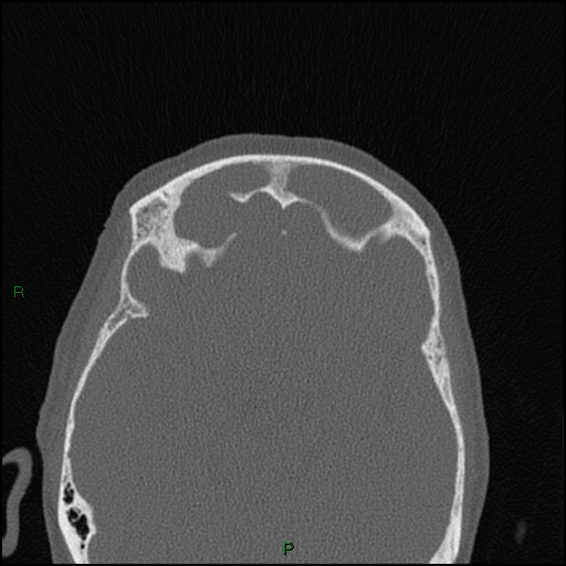 Bilateral frontal mucoceles (Radiopaedia 82352-96454 Axial bone window 101).jpg