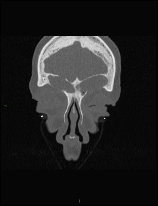 Bilateral frontal mucoceles (Radiopaedia 82352-96454 Coronal 66).jpg