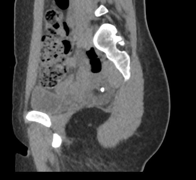 Bilateral mature cystic ovarian teratoma (Radiopaedia 88821-105592 D 16).jpg