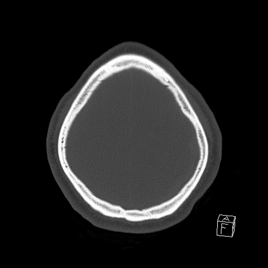 Bilateral occipital condyle fracture (type 2) (Radiopaedia 87675-104089 Axial bone window 116).jpg