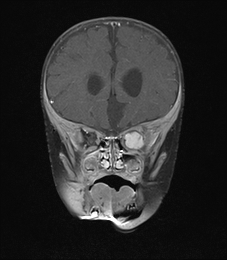 File:Bilateral optic pathway gliomas (Radiopaedia 40013-42514 D 4).jpg