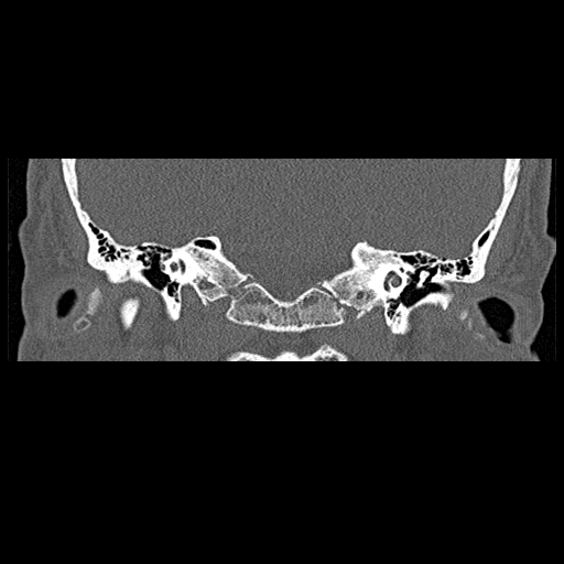 File:Bilateral ossifications of the external auditory canal (Radiopaedia 15233-15076 Coronal bone window 8).jpg