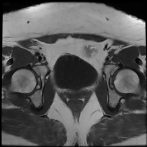 File:Bilateral ovarian dermoid cysts (Radiopaedia 90152-107338 Axial T1 17).jpg