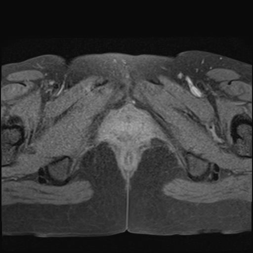 File:Bilateral ovarian endometriomas (Radiopaedia 87085-103347 Axial T1 fat sat 22).jpg