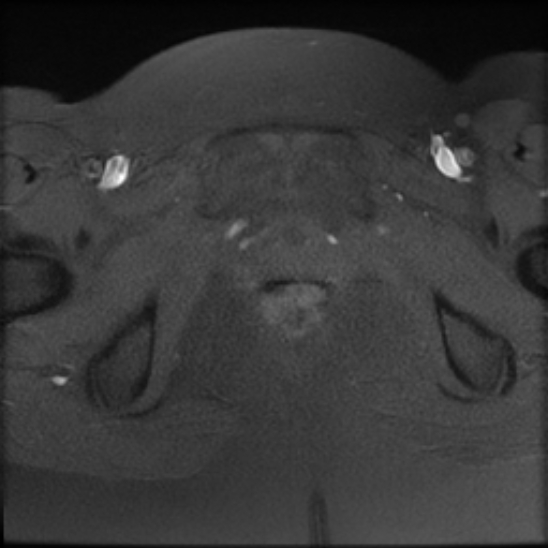 File:Bilateral ovarian fibrothecomas - adolescent (Radiopaedia 86604-102707 Axial T1 fat sat 27).jpg