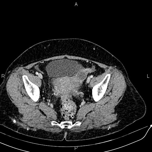 Bilateral ovarian serous cystadenocarcinoma (Radiopaedia 86062-101989 B 88).jpg